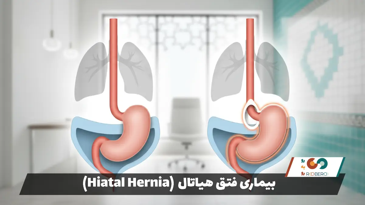 بیماری فتق هیاتال (Hiatal Hernia)
