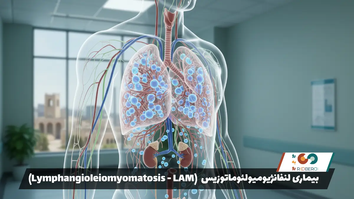بیماری لنفانژیومیولئوماتوزیس (Lymphangioleiomyomatosis – LAM)