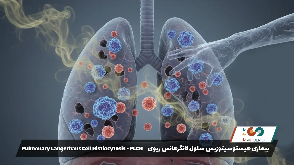 بیماری هیستوسیتوزیس سلول لانگرهانس ریوی (Pulmonary Langerhans Cell Histiocytosis – PLCH)