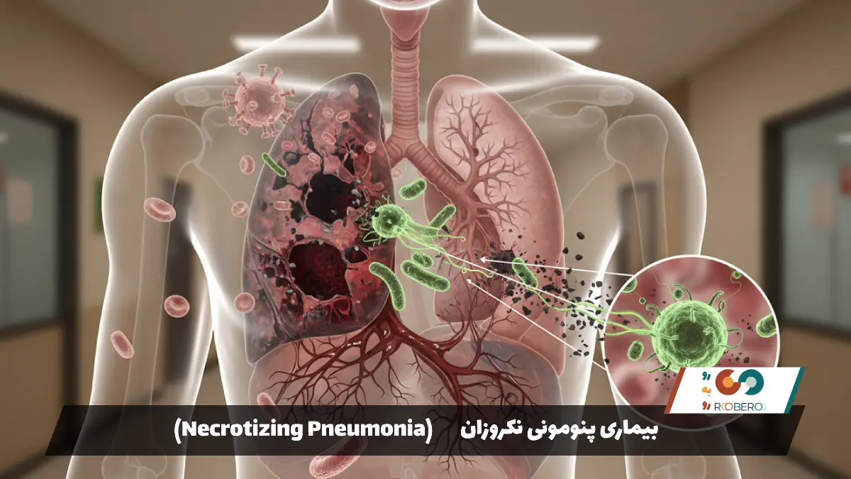 بیماری پنومونی نکروزان (Necrotizing Pneumonia)