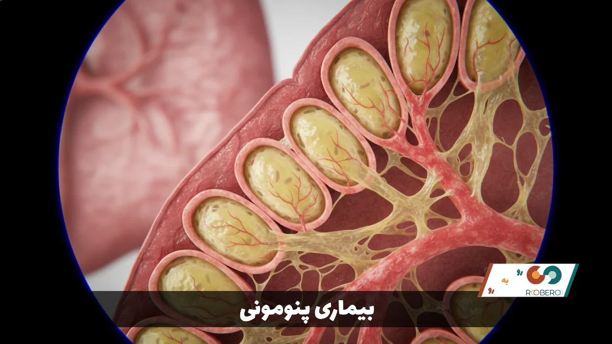 بیماری پنومونی (Pneumonia)