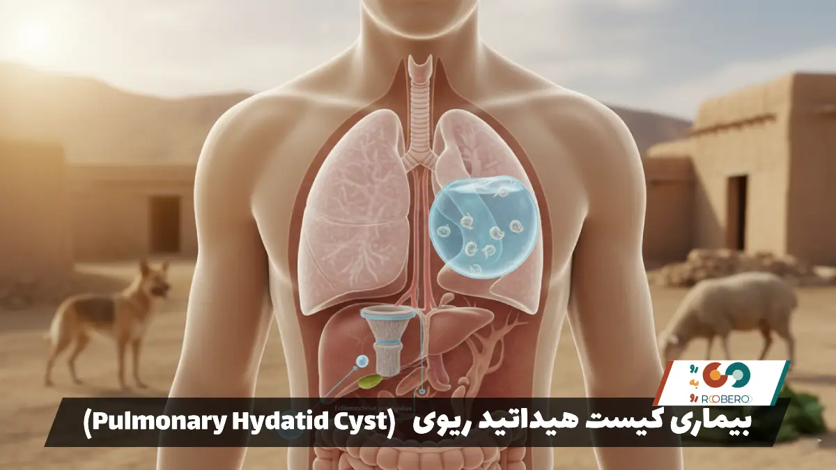 بیماری کیست هیداتید ریوی (Pulmonary Hydatid Cyst)
