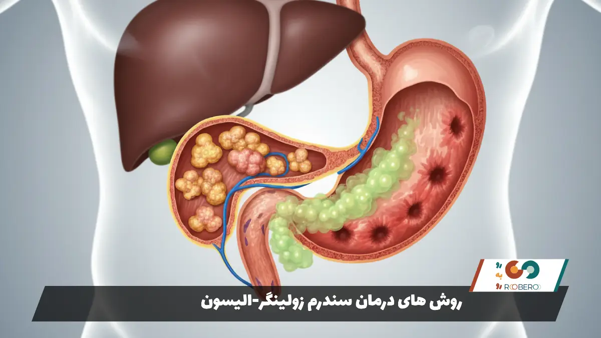 روش های درمان سندرم زولینگر-الیسون