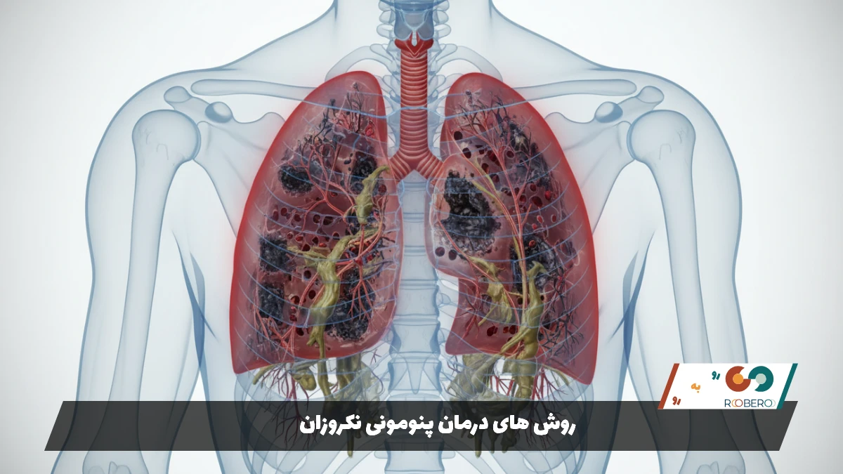 روش های درمان پنومونی نکروزان