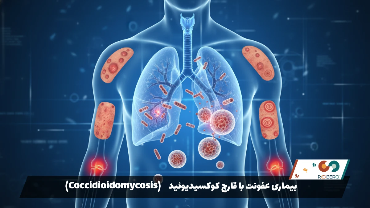 بیماری عفونت با قارچ کوکسیدیوئیدس (Coccidioidomycosis)