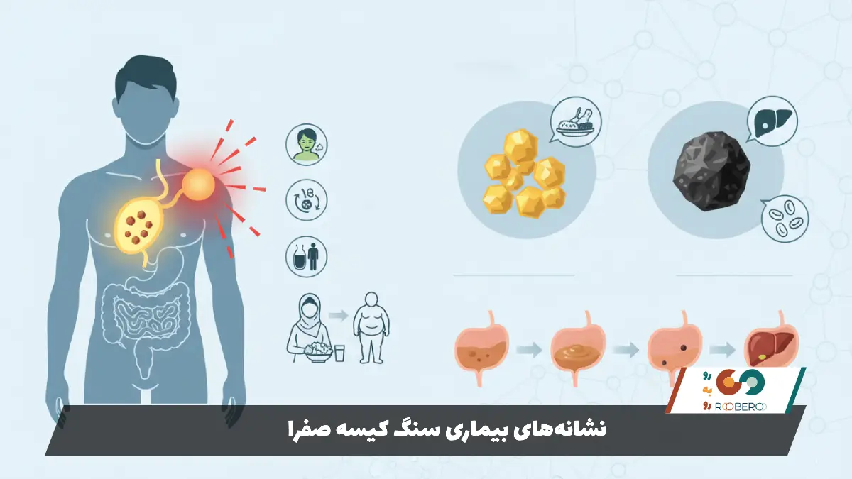 نشانههای بیماری سنگ کیسه صفرا