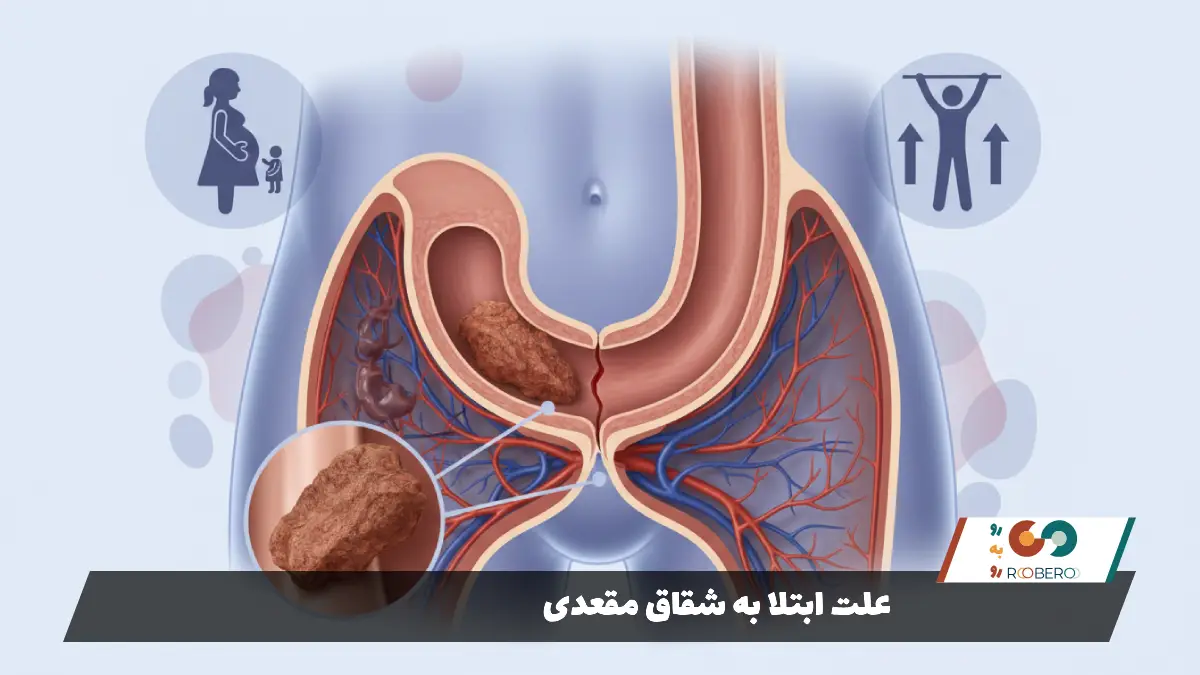 علت ابتلا به شقاق مقعدی