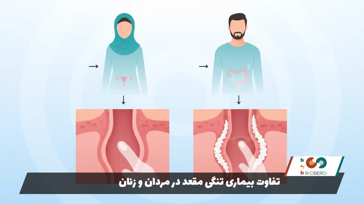 تفاوت بیماری تنگی مقعد در مردان و زنان