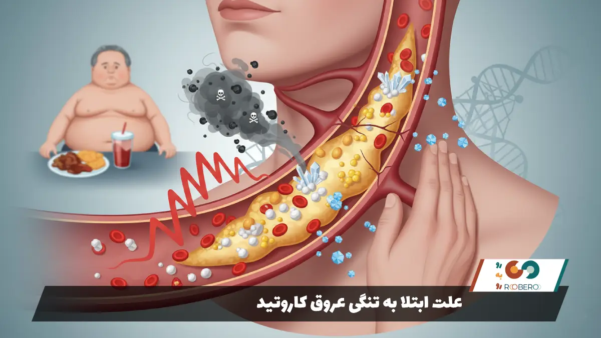 علت ابتلا به تنگی عروق کاروتید
