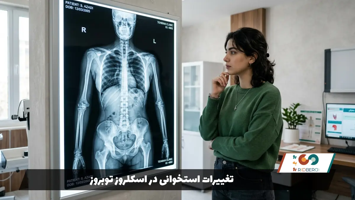 تغییرات استخوانی در اسکلروز توبروز 