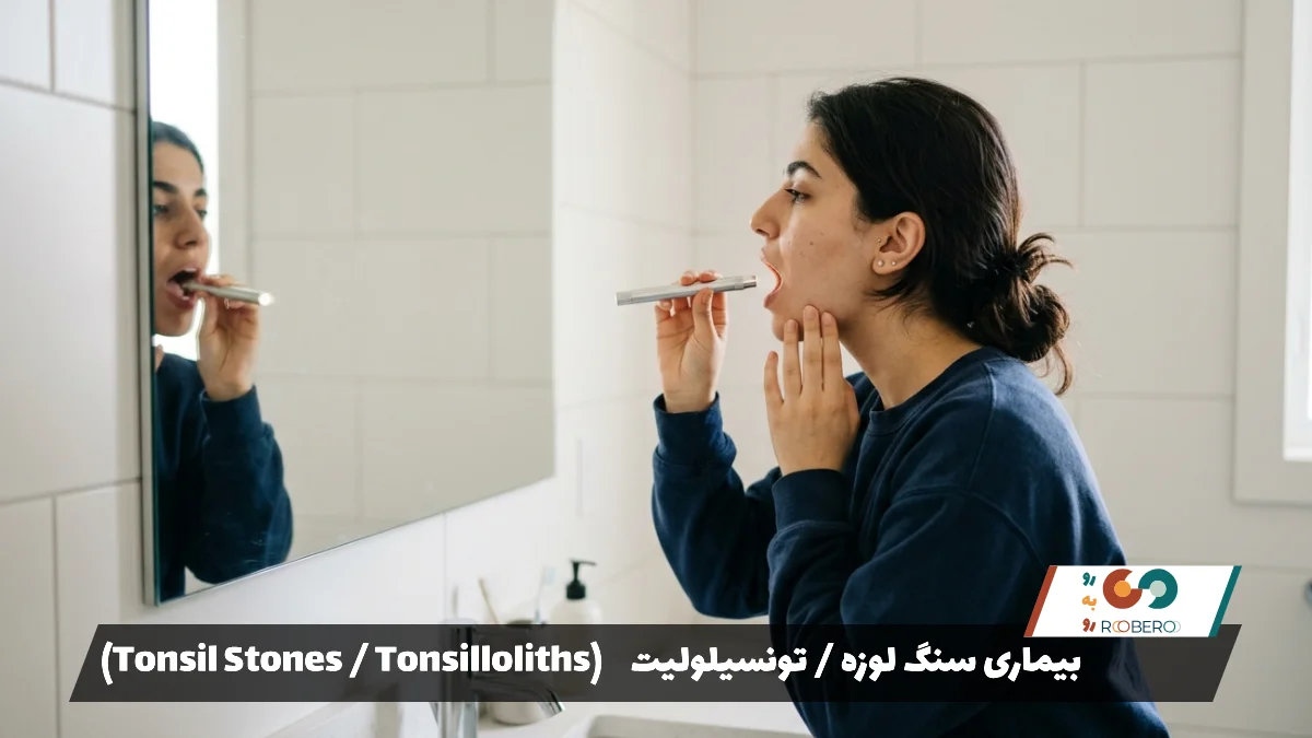 بیماری سنگ لوزه / تونسیلولیت (Tonsil Stones / Tonsilloliths)