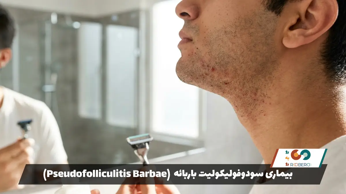 بیماری سودوفولیکولیت باربائه (Pseudofolliculitis Barbae)