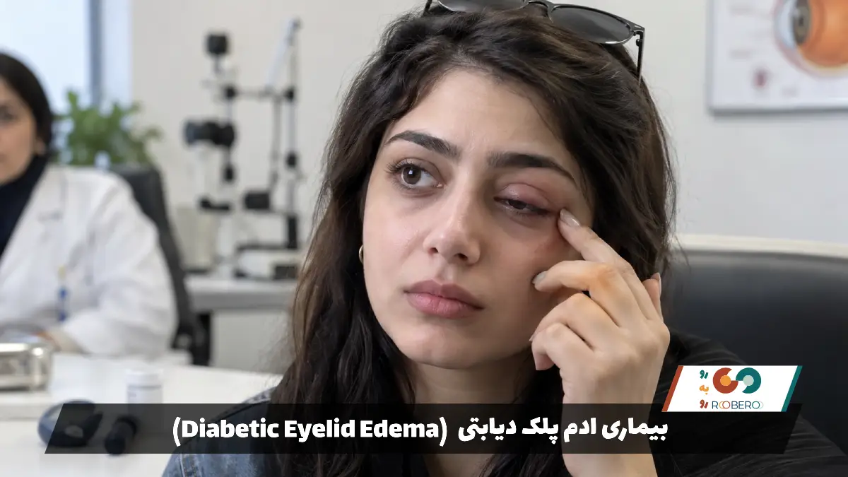 بیماری ادم پلک دیابتی (Diabetic Eyelid Edema)
